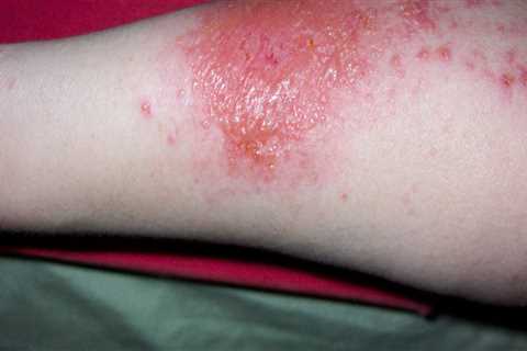 What does a poison ivy rash look like?